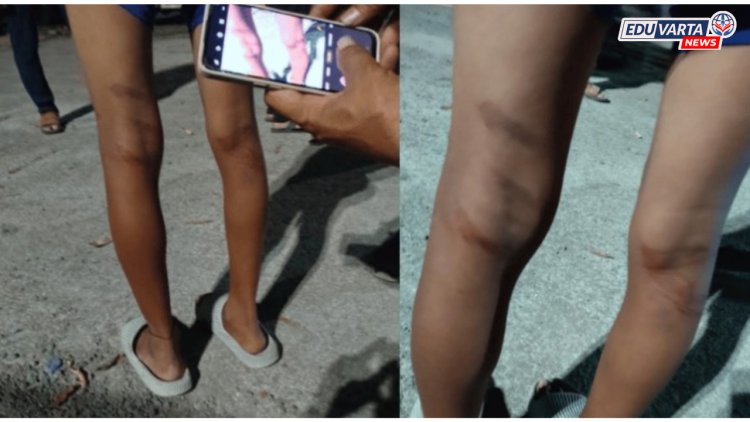 दुचाकीचे नुकसान केल्याच्या संशयावरून शिक्षकाकडून वसतिगृहातील ३२ विद्यार्थ्यांना अमानुष मारहाण